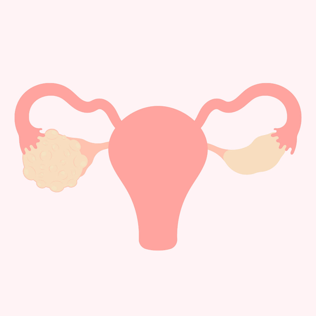 Polycystic ovarian syndrome (PCOS): a beginner’s guide