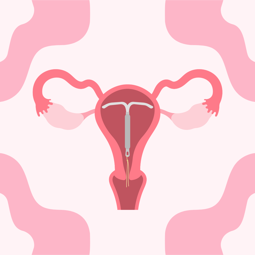 Mirena intra-uterine devices: the pros and cons!
